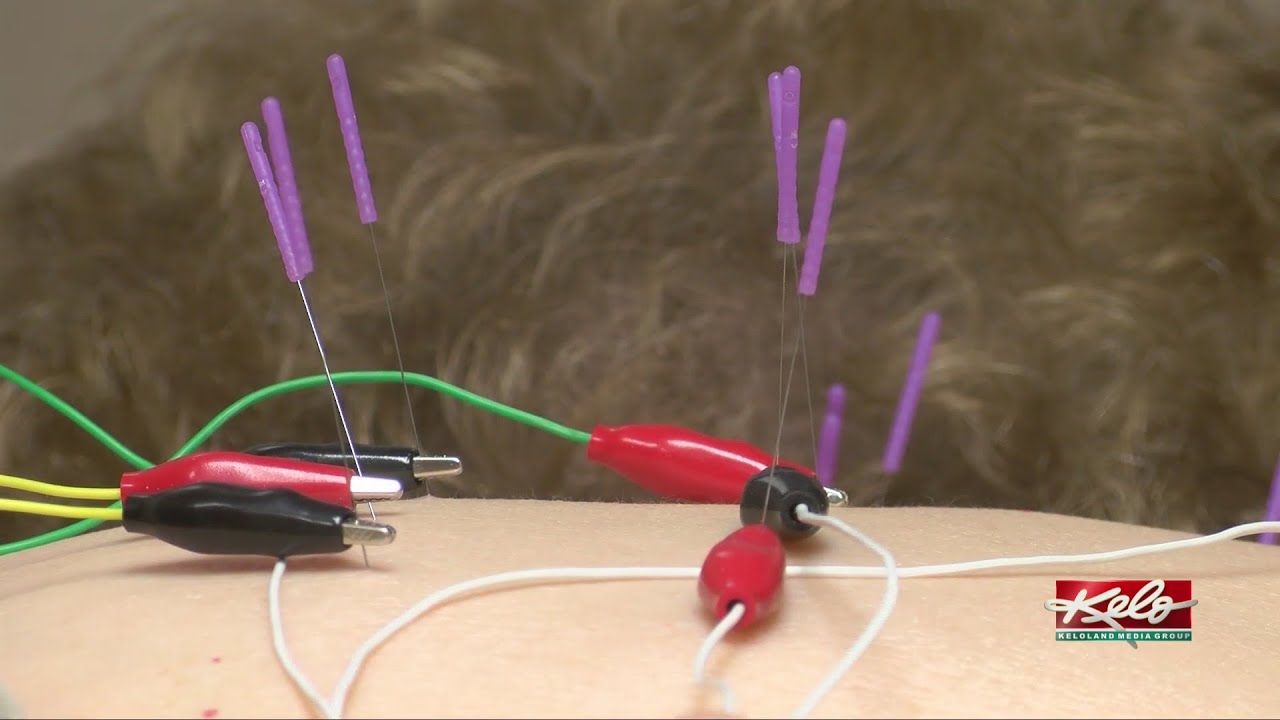 Acupuncture for chronic pain