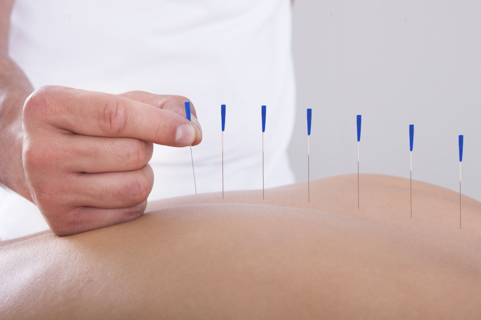 is acupuncture good for pain relief?