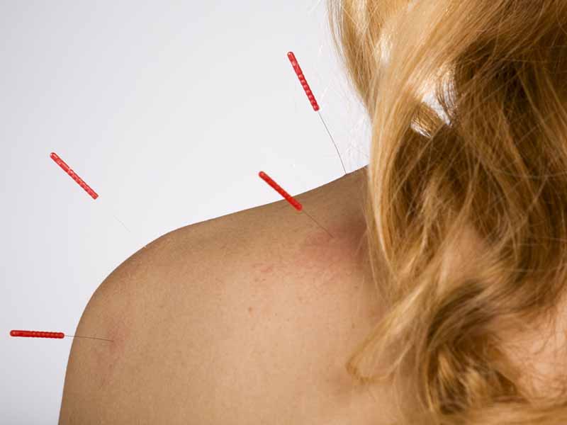 What role does acupuncture play in chronic pain relief?