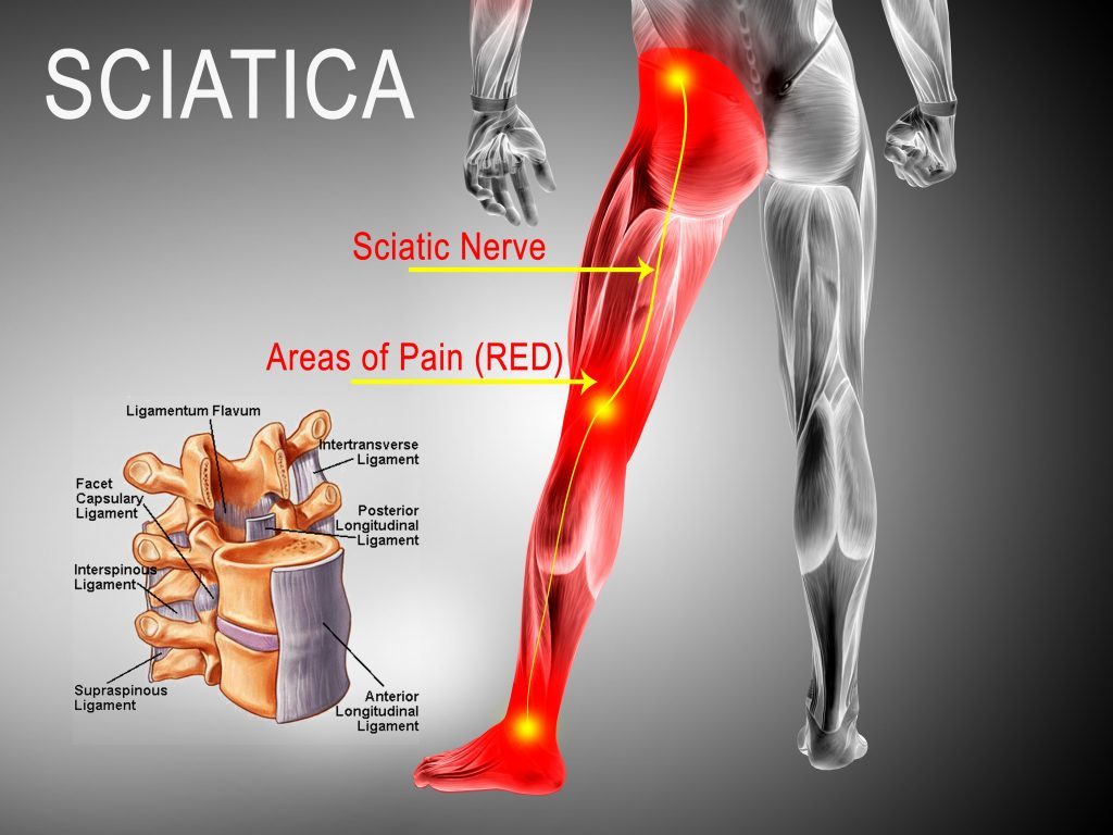 what is the most effective pain relief for sciatica?