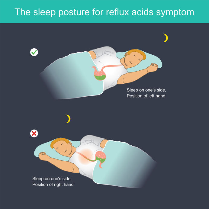 can you die from acid reflux in your sleep?